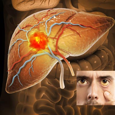 Liver diseases & jaundice treatment in kaninada